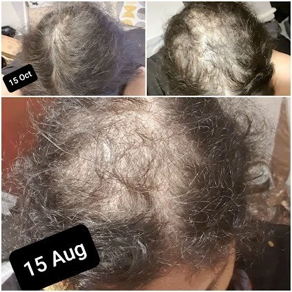 Patient scalp before and after treatment