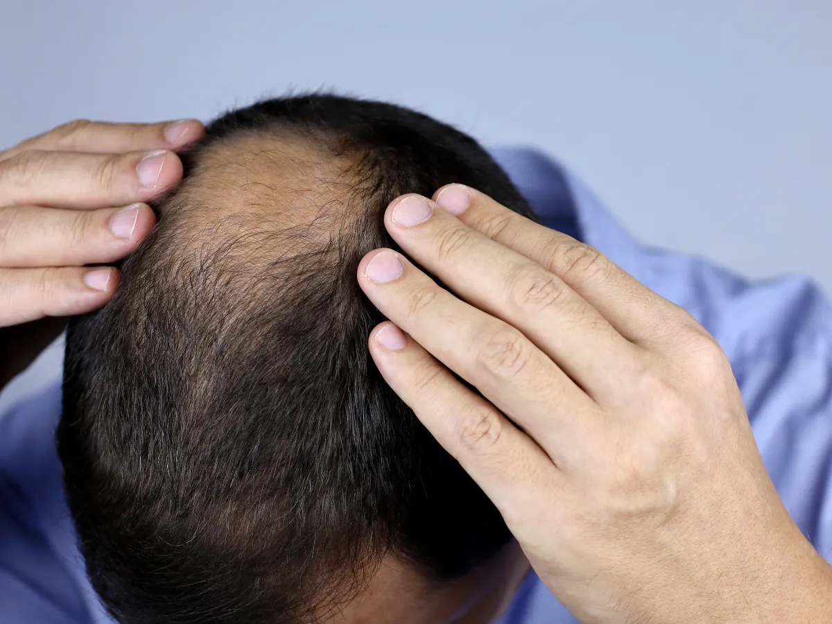 Male Pattern Baldness examination in Sussex