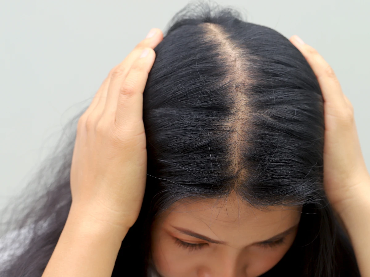 Post-Pregnancy Hair Loss