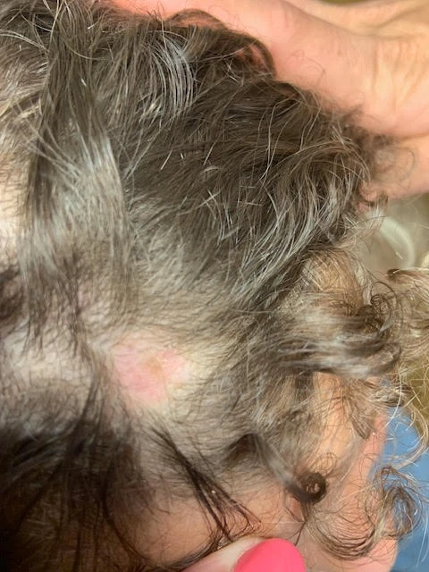 Alopecia Areata patch on a young patient