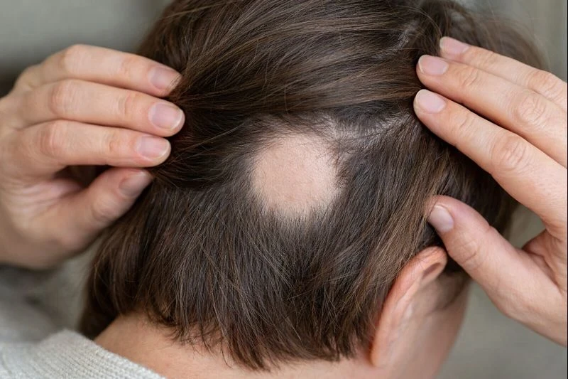 Round bald patch caused by Alopecia Areata