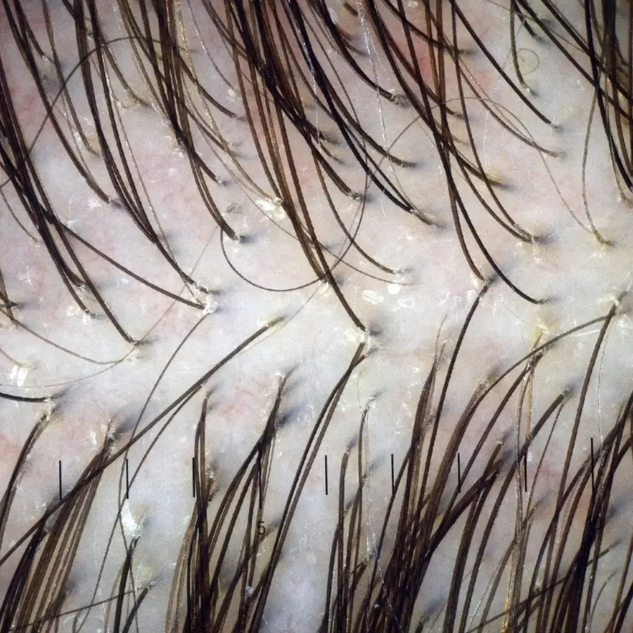 Scalp follicle close-up trichoscopy
