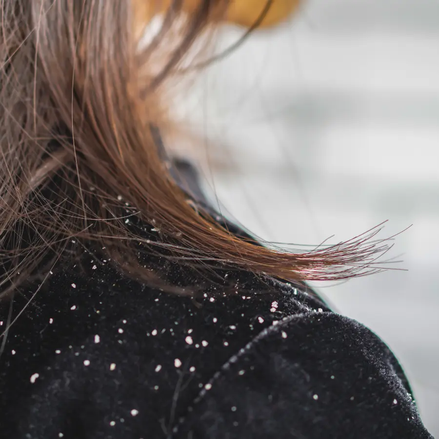 Dandruff treatment for scalp in Sussex
