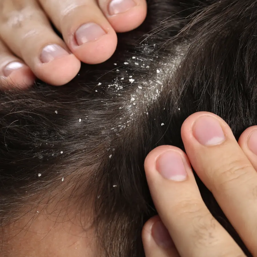 Dandruff