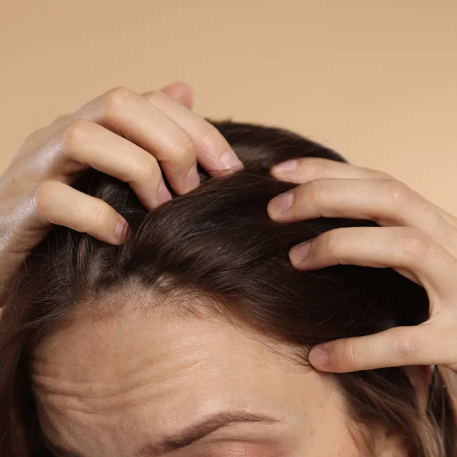 Seborrhoeic Dermatitis