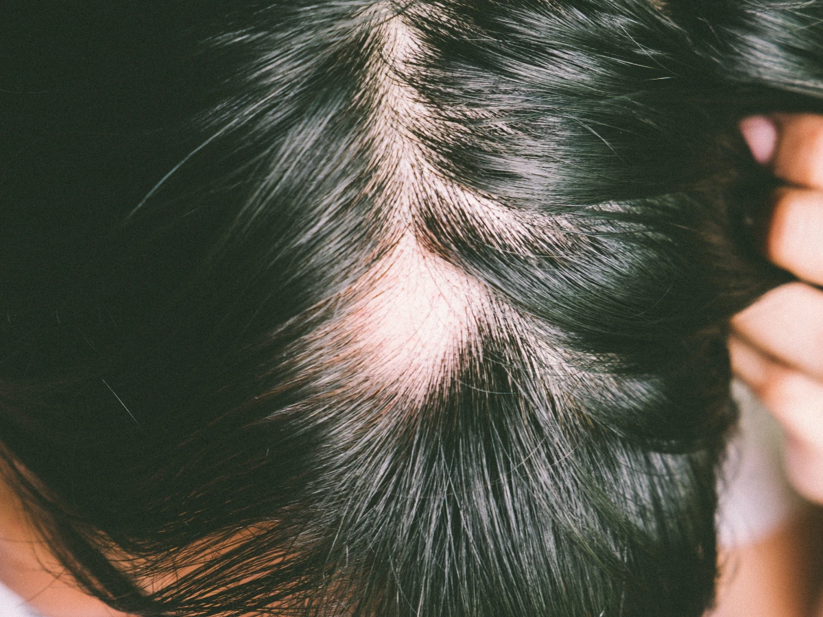 Traction Alopecia