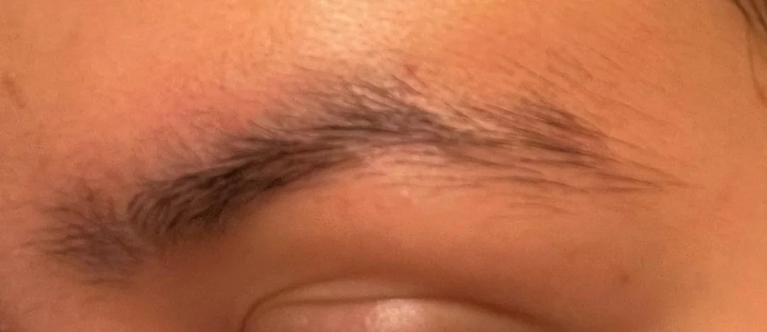 Thyroid and eyebrow hair loss